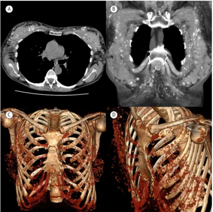 Figure 1. Axial (in A) and coronal (in B) CT reconstruction scans showing various bilateral round and oval nodules with  rim calciications in the anterior chest wall