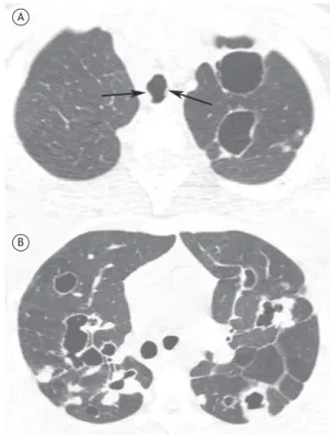 Figure 3. Axial CT scans at the level of the upper lobes  (in A) and below the bronchial bifurcation (in B), showing  solid and cavitated nodules in both lungs, with thick or thin  walls