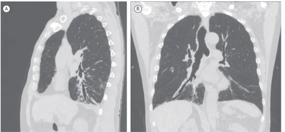 Figure 2. In A, sagittal chest CT scan demonstrating bronchiolectasis, atelectasis, and areas of ground-glass opacity in  the lower lobes
