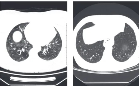 Figure 3. Axial chest CT scans showing areas of ground-glass attenuation in the left lower lobe.