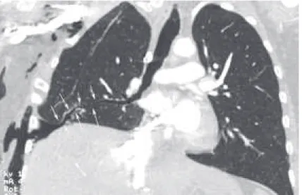 Figure 1. Curved coronal CT reconstruction showing a bronchopleural istula in the anterior segment of the right lower lobe.