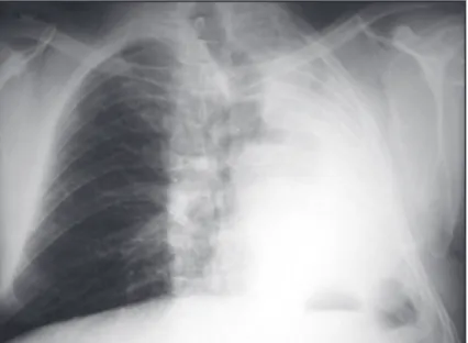 Figure 1.  Anteroposterior  chest  X-ray  showing  diffuse  opaciication  of  the  left  hemithorax  (opaque  hemithorax)
