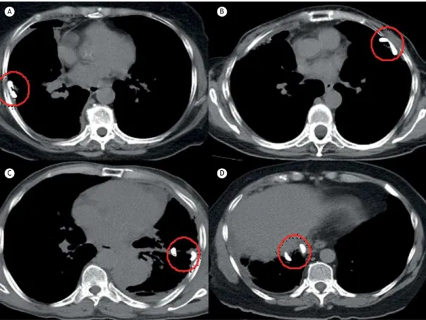 Figure 1. Positioning of the pleural catheter on CT scans. A: posterolateral; B: anterior; C: issural; and D: subpulmonary.