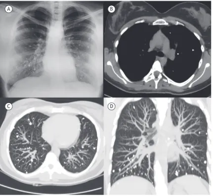 Figure 1. In A, anteroposterior chest X-ray showing innumerable, coarse and punctate micronodules with high calciic density  throughout both lungs; in B, axial HRCT scan (mediastinal window) showing no mediastinal calciied lymph nodes