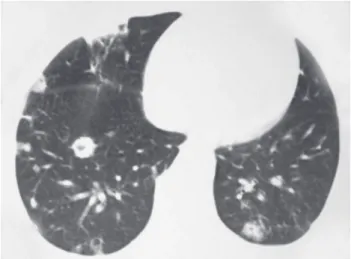 Figure 1. CT scan with lung window settings at the level of the lung bases, showing multiple nodules of various sizes,  many of which were cavitated, with a predominant peripheral distribution.