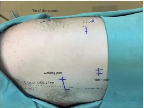 Figure 1. Anatomical representation of the surgical technique used.