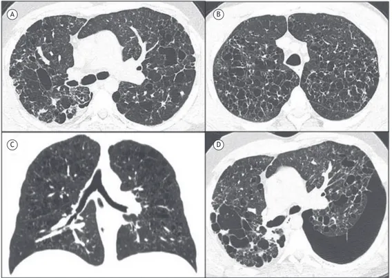 Figura 1. Imagens de TC de pacientes com histiocitose pulmonar de células de Langerhans