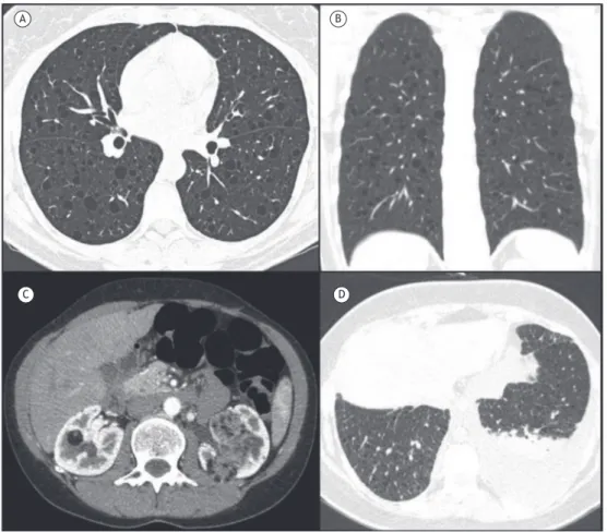 Figura 2. Em A, reconstrução axial e, em B, reconstrução coronal de imagens de TC de tórax de uma paciente do sexo  feminino com linfangioleiomiomatose, apresentando cistos pulmonares difusos e de paredes regulares
