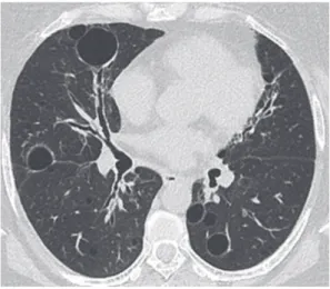 Figura 3. Imagem de TC de tórax em reconstrução axial  demonstrando pneumonite intersticial linfocítica em uma  paciente do sexo feminino com síndrome de Sjögren