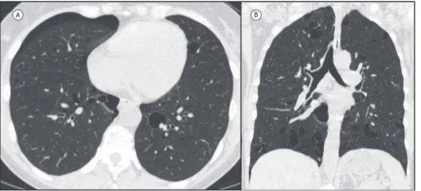 Figura 5. Em A, imagem de TC em reconstrução axial demonstrando cistos pulmonares de paredes inas associados a  pneumotórax à direita
