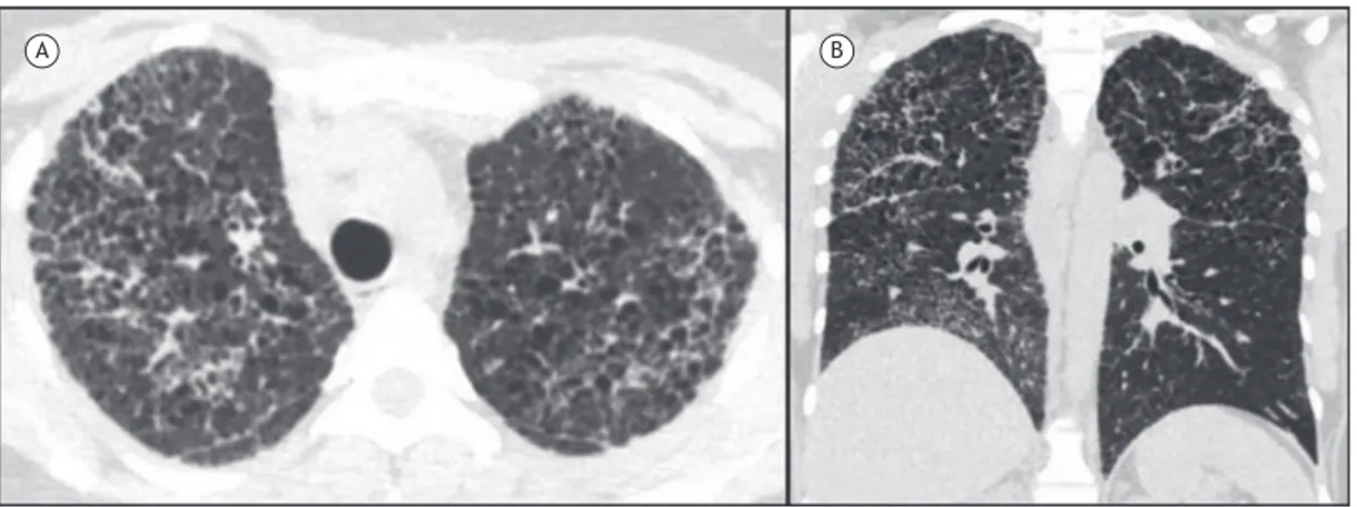 Figura 6. Imagens de TC de tórax. Em A, imagem em reconstrução axial demonstrando várias imagens císticas de  paredes inas associadas ao espessamento de septos interlobulares e micronódulos pulmonares