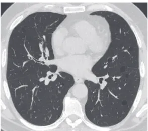 Figura 11. Imagem de TC em reconstrução axial de uma  paciente portadora de esclerose sistêmica (forma limitada)  e padrão de pneumonite intersticial descamativa conirmado  por biópsia pulmonar a céu aberto