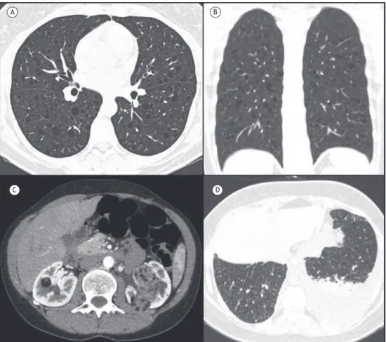 Figure 2.  In  A,  axial  reconstruction  and,  in  B,  coronal  reconstruction  of  chest  CT  scans  of  a  female  patient  with  lymphangioleiomyomatosis, showing diffuse lung cysts with regular walls