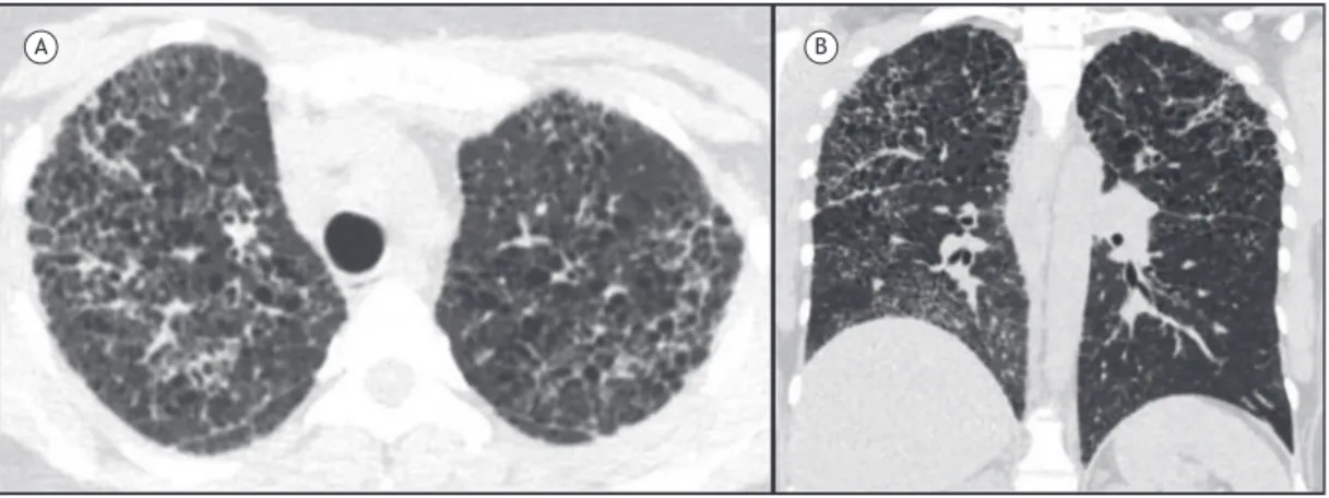 Figure 6. Chest CT scans. In A, axial reconstruction demonstrating several thin-walled, cystic structures associated with  interlobular septal thickening and pulmonary micronodules