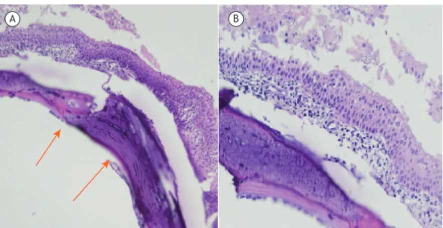 Figura 3.  Em  A,  tecido  cartilaginoso  anormal  em  região  de  submucosa  com  ossiicação  metaplásica  (setas;  H&amp;E; 