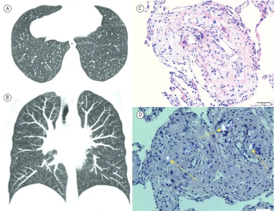 Figure 1. Axial (in A) and coronal (in B) reformatted CT images showing numerous small bilateral centrilobular nodules,  associated with the tree-in-bud pattern
