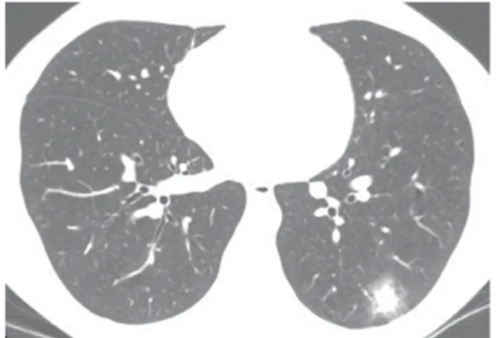 Figure 1. CT scan of the chest with lung window settings at the level of the lower lobes, showing a soft-tissue density nodule  located in the left lower lobe and surrounded by a halo of ground-glass opacity (the halo sign)