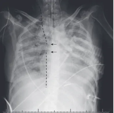 Figure 3. An X-ray of the chest (taken with a portable X-ray machine at the bedside) of a patient with hypoxemic  respiratory failure submitted to extracorporeal membrane oxygenation support