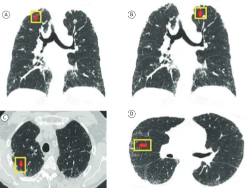 Figura 1. TC de tórax em plano coronal (A) e axial (B, C e D) demonstrando intensa ibrose em região pleural e  subpleural e espessamentos septais com predomínio em lobos superiores e nódulo espiculado no lobo superior esquerdo.