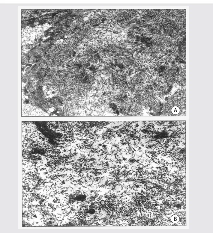 Figure 2 – Focal and extensive fragmentation of collagen fibrils, associated with the presence of dark deposits (focal electron dense change) and clear areas of rarefaction, observed in rats treated with carbon tetrachloride for 12 weeks, 2 weeks (A) and 1