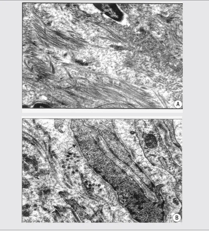 Figure 3 – A – Group II, 2 weeks after treatment. Area of densely packed collagen fibrils showing at the center a clear zone of rarefaction and focal electron-dense granular material (arrow heads)