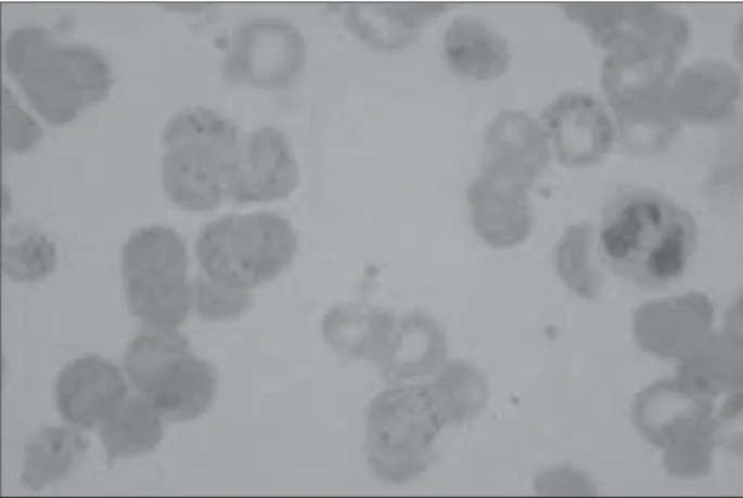 Figure 1  – Blood smear of peripheral blood. Source: LM SL