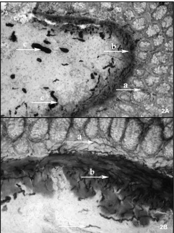 Figure 3 – Histological section of colectomy of patient (99B-1018) with HD stained  by H&amp;E showing hypertrophic nerves (arrow) in the myenteric plexus (x 100)Graph 1 – Age groups (in months) of the 68 patients surgically treated with 