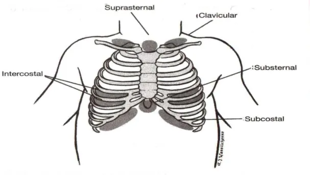 Figura 2 - Tiragem por região anatómica (Fonte: ENPC – Provider manual) 