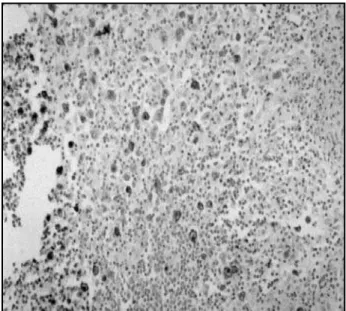 Figure 1 – Microscopic demonstration of EBV markers in classical Hodgkin’s  lymphoma NS-subtype by in situ hybridization (400x)