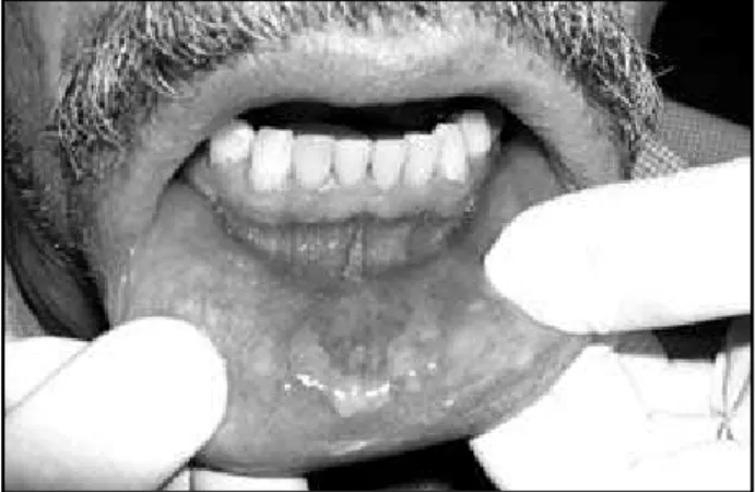 Figura 1 – Lesão ulcerada, eritematosa recoberta por membrana esbranquiçada na  mucosa interna do lábio inferior