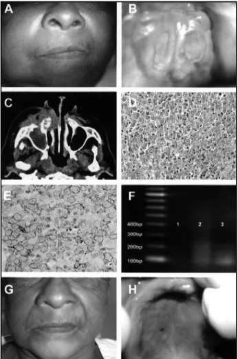 Figure 1 – A: Asymmetry and swelling of the right side of the face; B: tumoral swelling in  the palate with two 3-cm eroded areas; C: computed tomography demonstrated invasion  of maxillary sinus, nasal cavity and soft tissue of the right side; D: neoplast