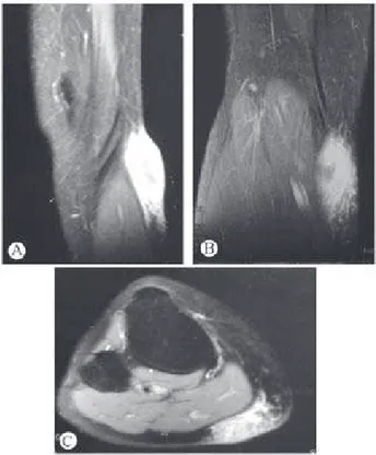 Figure 1 – Fat suppressed contrast-enhanced T1-weighted magnetic resonance imaging  of the posterior leg