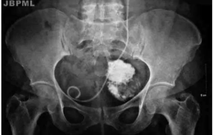 Figure 1 –  Radiograph of the pelvis. A calcified mass with ovoid shape in left pelvis