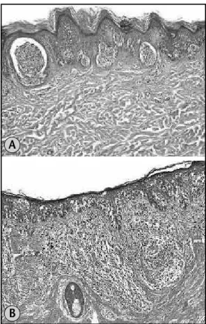 Figure 2 –  (a) Well circumscribed melanoma HE 10×;  (b) poorly circumscribed  melanoma HE 10×