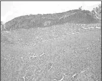 Figure 6 –  Melanoma with epidermal atrophy HE 20× Figure 7 –  Ulcerated melanoma HE 20×