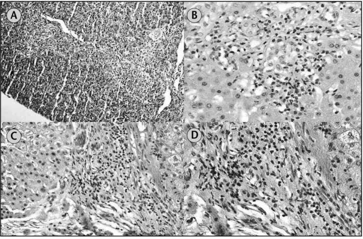 Figura 1 – Photomicrograph of different PT. (A) Medium power view of two PT with mild active mixed lymphocytic and neutrophilic inlammation surrounding and involving bile  ducts (20×); (B) high power view of PT with moderate mixed inlammation (40×); (C) me