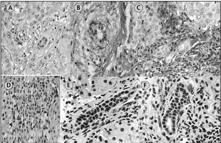 Figura 2 – Photomicrographs of different BD. (A and B) Medium and high power views of BD showing dystrophic changes of bile ducts with mild inlammation and sclerosis (20× 