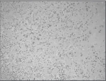 Figure  5  – Epithelioid trophoblastic tumor: immunohistochemical staining showed  negativity for HCG