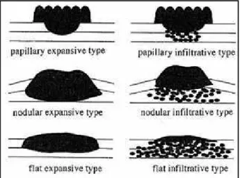 Figure 2 – Macroscopic classification of advanced gallbladder cancer (7)