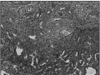 Figure 4 – Advanced gallbladder cancer. Malignant glandular structures invade the  gallbladder wall (H&amp;E, 10×)