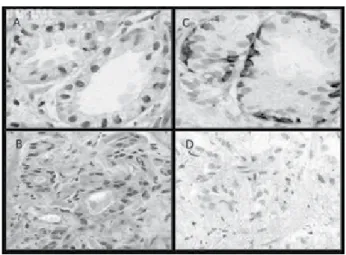 Figure 6 – Final diagnosis by IHC of cases diagnosed as ASAP in the initial series  (n = 35)