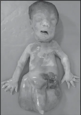 Figura 1 – Caso 1: feto macerado com membro inferior único rudimentar, agene- agene-sia de genitália externa, volumosa mielomeningocele lombossacra e gastrosquise  expondo alças intestinais