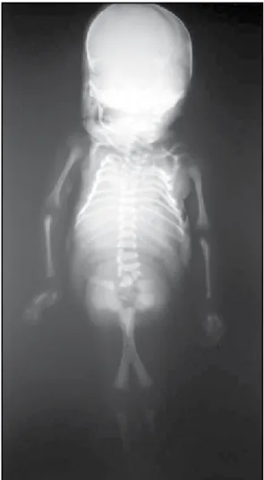 Figura 9 – Caso 3: radiografia mostrando fusão parcial dos fêmures, duas tíbias e  uma fíbula tipo IV de Stocker e Heifetz (15)
