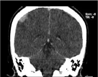Figure 1 –  Preoperative CT scan showing an expansive mass in the right parietal  convexity