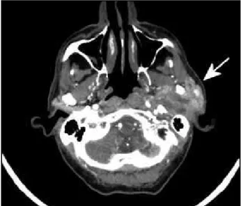 Figure 1 – Computed tomography showing a heterogeneous mass in the left parotid  region