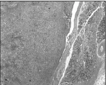 Figure 4 – Photomicrographs of HE stained sections showing microscopic featu- featu-res of the carcinosarcoma