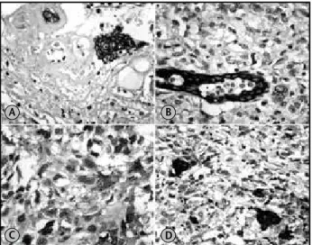 Figure 5 – Photomicrographs showing immunohistochemical features of the   carcinosarcoma