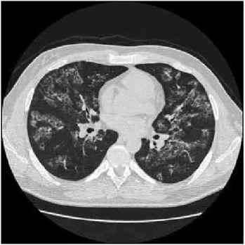 Figure 1 – Computed tomography of chest 
