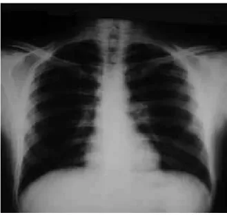 FIGURE 1 –  Chest radiographic image of Case 2 patient at hospital admission