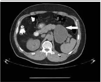 FIGURE 2 –  Pancreatic dermoid cyst: thickened cystic wall, with several  micronudulations on surface and pasty homogeneous yellowish content of  caseous aspect